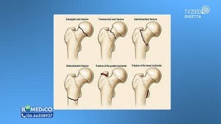 Il Mio Medico  Fratture del femore come si riconoscono [upl. by Resarf227]