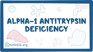 Alpha1 Antitrypsin Deficiency  causes symptoms diagnosis treatment pathology [upl. by Howland626]