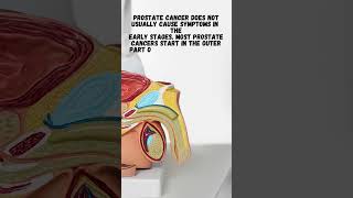 Does prostate cancer cause symptoms in the early stages [upl. by Joshi]