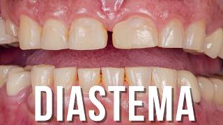 DIASTEMA [upl. by Natassia]