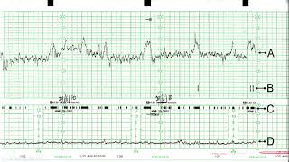 CTG in Practice Part 2 [upl. by Ettolrahs224]