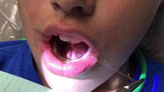 Functional frenuloplasty updated technique with lingual palatal suction [upl. by Meridel]