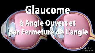 Pathologie du Glaucome Animation [upl. by Nwahsyt414]