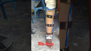 Tibia Brace [upl. by Aretina354]