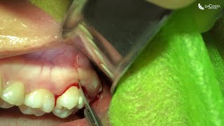 Exodontia de terceiro molar superior Upper wisdom tooth extraction [upl. by Notselrahc470]