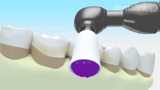 LIMPIEZA periodontal supragingival Sarro dental  Video 3D [upl. by Ahsiem]