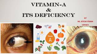 Vitamin A  Sources amp Function I Deficiency DisordersXeropthalmia blindness amp their management [upl. by Yovonnda]