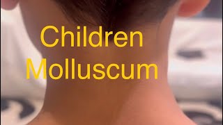 Children Molluscum treatment Don’t worry Just Don’t manipulate and scratch or cryo or acid [upl. by Ninehc]