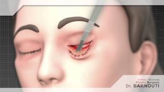 Cosmetic Surgery Animated Video  Eyelid Surgery [upl. by Iharas]