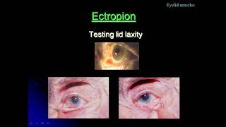 A Class On Ectropion By Dr VivekanandDept Of Ophthalmology [upl. by Nniuq]