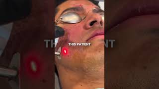 How to treat Icepick  Boxcar Acne Scars acnescarsremoval acnescartreatment [upl. by Ativ]