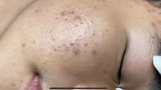 ACNE TREATMENT VU QUYNH MI  Perennial Blackheads On Boy Face 2024FULL [upl. by Regan]