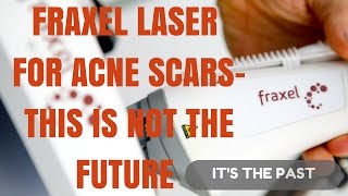 How to treat acne scars NOT with Fraxel Laser [upl. by Niffirg865]