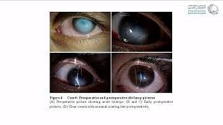 Corneal Hydrops Rethinking Treatment [upl. by Rabka299]