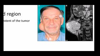 pleomorphic adenoma [upl. by Hertz]