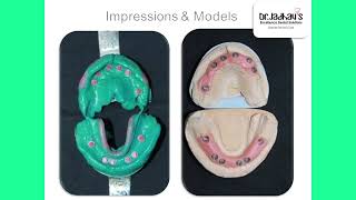 All teeth fixed by Dental Implants by Dr Vivek Jadhav [upl. by Kinzer]