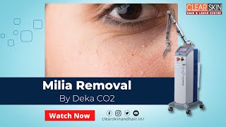 How to Remove Milia Permanently  Milia Removal Treatment by Deka CO2 Laser  Causes amp Symptoms [upl. by Adnolohs]