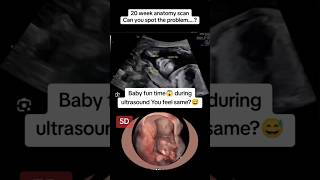 20 weeks anotomy scan fun time on ultrasound😅🫢viralvideo trending viralshorts [upl. by Eceryt]