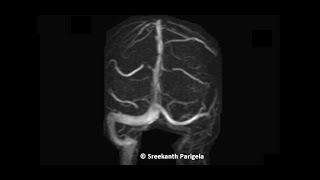 Hypoplastic Left Transverse sinus  MRV [upl. by Ardnuek]