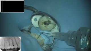 LIVE ENDODONTIC TREATMENT  first upper molar 40 minutes 4 canals [upl. by Joash]