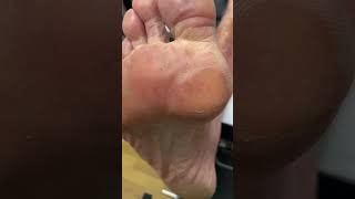 Join our Australian Podiatrist for a smooth journey of forefoot callus removal [upl. by Gussman]