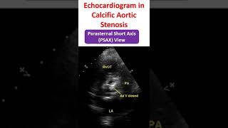 Echocardiogram in Calcific Aortic Stenosis [upl. by Hgielram582]