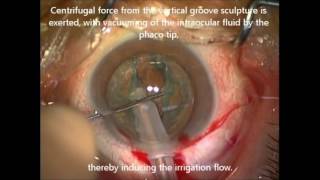 iH during phacoemulsification cataract surgery  ID 124528 [upl. by Olenta902]