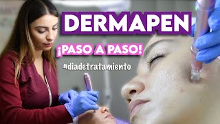 DERMAPEN  TRATAMIENTO DE MICRONEEDLING  Ximena Ramaya [upl. by Borman]