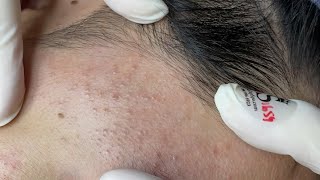 Its Not Clean Like We See A lot of Acnes under Skin  Spa ASMR  Cleaing ASMR [upl. by Sibbie178]