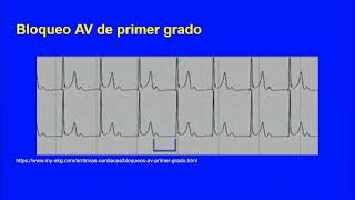 UT5  Bradiarritmias Dr Fata [upl. by Buine210]