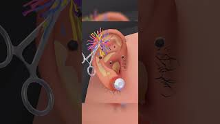 ear 👂 infection cleaning asmr gamingvideos [upl. by Nahpets]