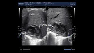 Ultrasound Video showing Hepatic hydatid cyst [upl. by Filippo]