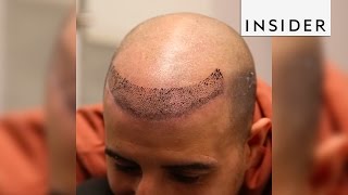 Scalp micropigmentation is a nonsurgical hair loss treatment [upl. by Atikkin]