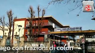 Aou di Novara intervento di ricostruzione dellesofago con frazioni di colon [upl. by Drais]