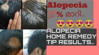 ALOPECIA AREATA HOME TREATMENT RESULTS MALYALAMll വട്ടത്തിൽ മുടി കൊഴിച്ചിൽ ll MIND ME ENTERTAINMENTl [upl. by Novaj]