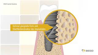 Was ist ein Zahnimplantat Ein Erklärvideo für Patienten von BEGO Implant Systems [upl. by Airehs]