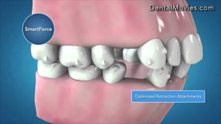 Invisalign G6 Clinical Innovations for First Premolars Extraction [upl. by Netaf]