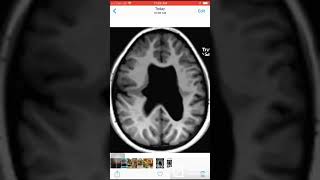 Case 036 Closed lip Schizencephaly and absent septum pellucidum [upl. by Zeb]