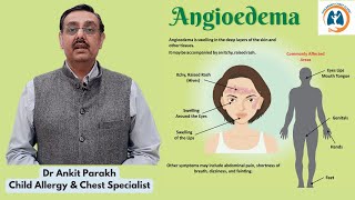 Angioedema in children Symptoms Diagnosis amp Treatment Dr Ankit Parakh Allergy Specialist [upl. by Hgieliak]