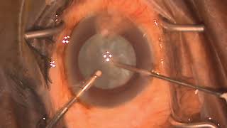 AJO  Video IampA decompression of intumescent cataract Deshmukh’s Technique [upl. by Palmore284]