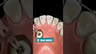 The most common methods used to bring palatally impacted canines into occlusion [upl. by Phaidra]