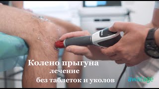 Колено прыгуна Лечение при помощи аппаратов ударноволновой терапии GYMNA [upl. by Telocin]