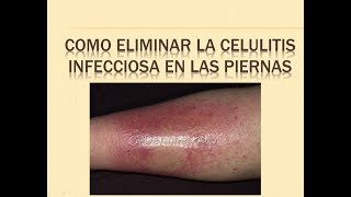 COMO ELIMINAR LA CELULITIS INFECCIOSA EN PIERNAS 🐩 REMEDIOS caseros para la celulitis infecciosa [upl. by Ailedua]