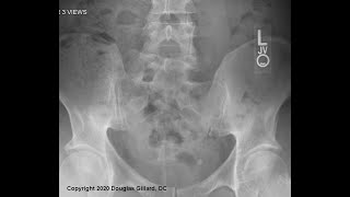 Posterior Sacral Anatomy  Two Malformations of the Lumbosacral Joint Sacralization  Lumbarization [upl. by Eltsyrhc]