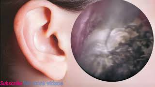 Satisfying Video Ear Wax Removal  how to remove ear wax removal by endoscopic long video 5 [upl. by Illil798]