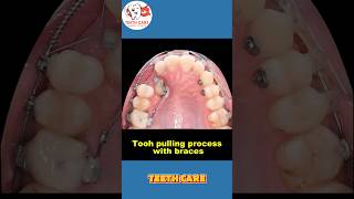 braces transformation teeth braces dental dentalcare dentalhealth dentalimplants shorts [upl. by Romeon]