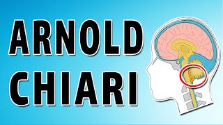 Arnold Chiari Malformations [upl. by Karyl]