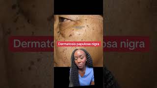 Why Do I Have These Dark Skin Spots Understanding Dermatosis Papulosa Nigra [upl. by Ennaid126]