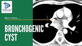 Bronchogenic cyst Umamaheshwar Reddy V [upl. by Tutt]