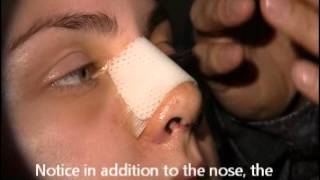 Cleaning your nose after Rhinoplasty [upl. by Goff]